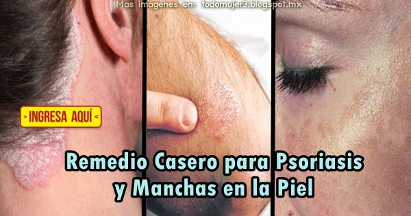 La eccema que se moja en la pierna